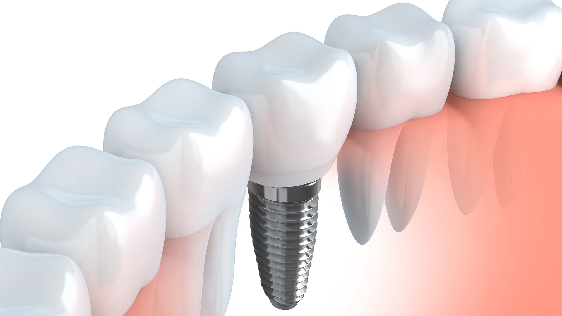 https://dentalcc.com.au/wp-content/uploads/2021/11/Implants.jpg