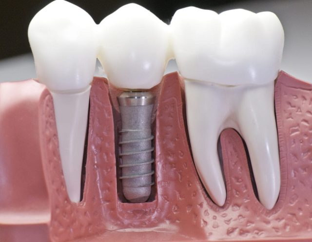 Dental Implants 3D diagram